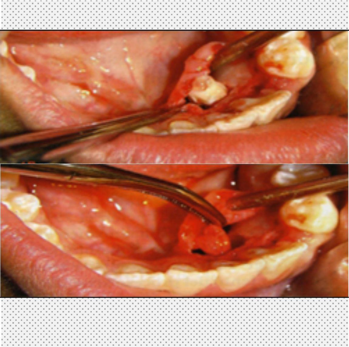 Cirugía dental