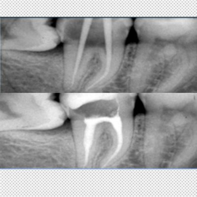 endodoncia-dental