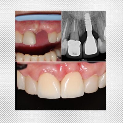 implante-dental