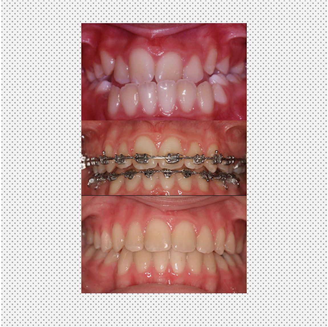 Ortodoncia vestibular
