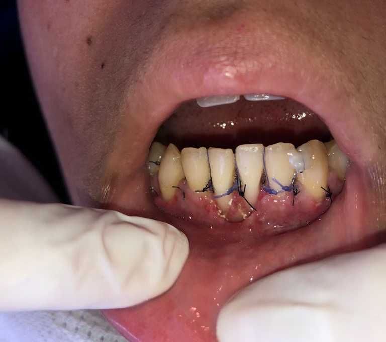 Periodoncia